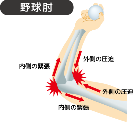 野球肘のメカニズムのイラスト