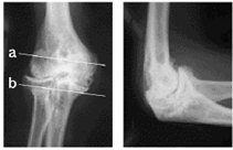 変形性肘関節症のレントゲン写真