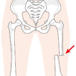 大腿骨骨幹部骨折のイラスト