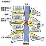 変形性頚髄症のイラスト