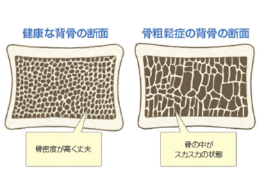 骨粗鬆症外来